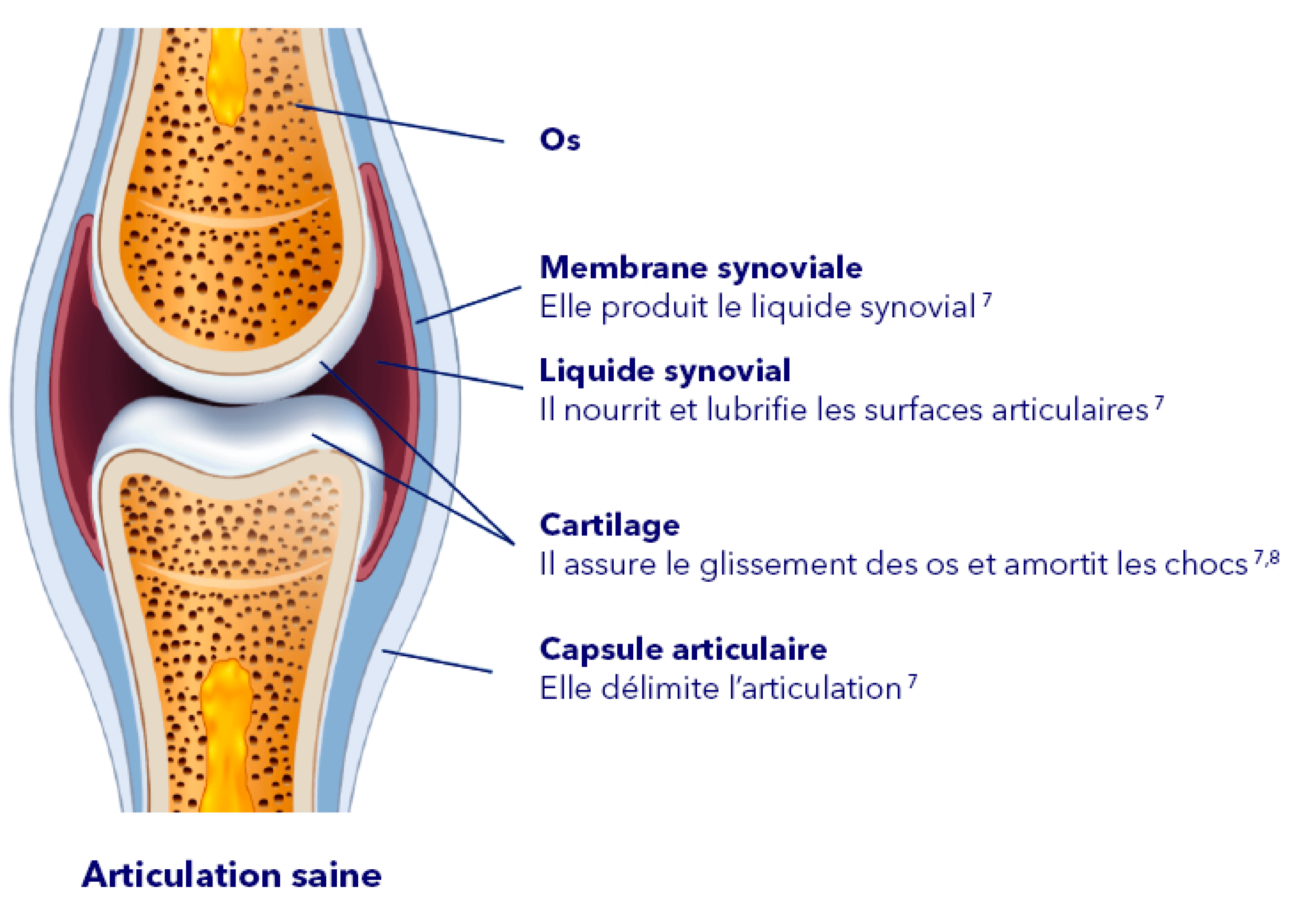 Arthrose définition - Qu'est-ce que l'arthrose du genou ?
